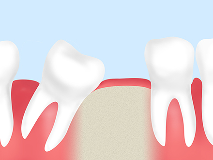 歯を失ってしまったらインプラントで噛む機能を回復しませんか？